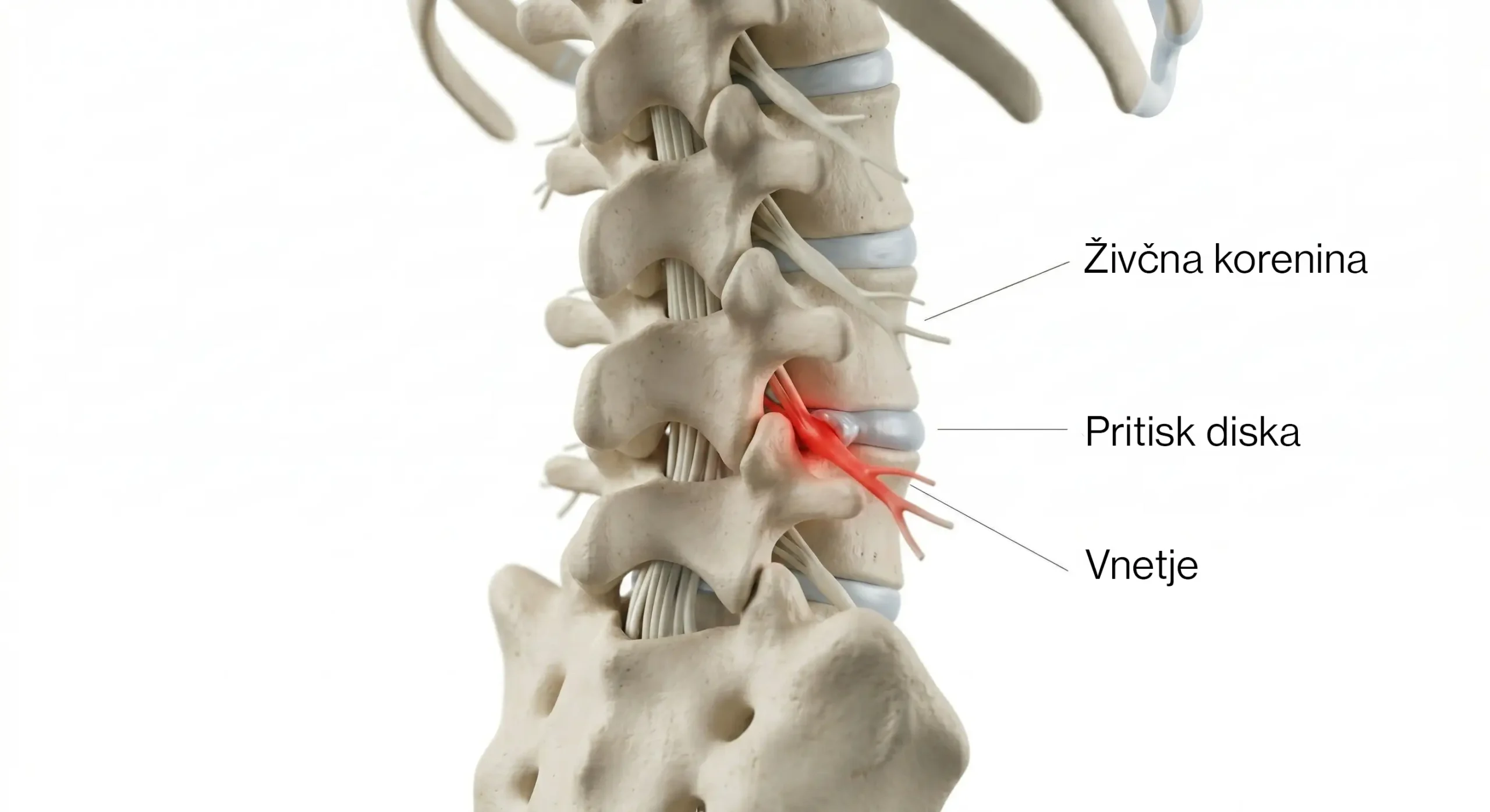 pritisk na živčno korenino zaradi hernije diska in vnetja v ledvenem delu hrbtenice